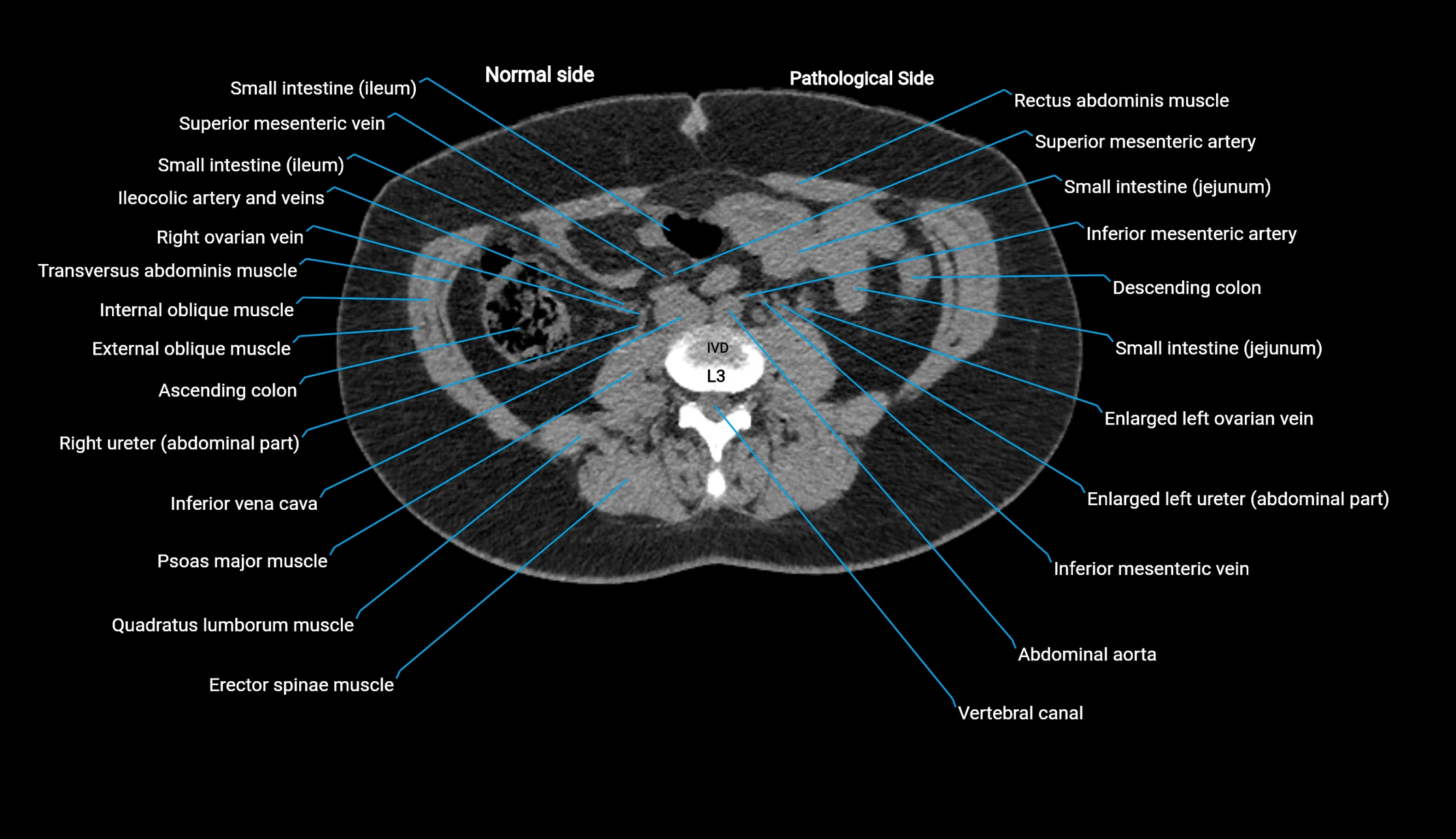 CT KUB axial cross sectional anatomy  radiology image -img-00201-00077.webp